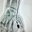 Distal radial access. Occlussion of the ...