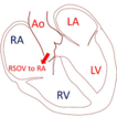 Ruptured sinus of Valsalva aneurysm: ...