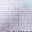 Pyridostigmine induced symptomatic bradycardia ...
