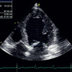 Acute myocarditis in a patient with parainfluenza ...