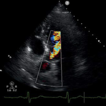 Transcatheter aortic valve implantation ...